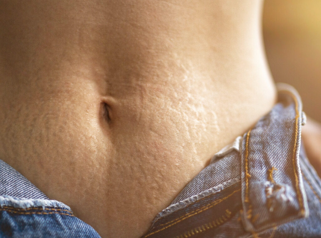 Rozstępy – na piersiach, na udach, na brzuchu, na plecach
