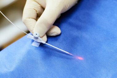 Laserowe leczenie żylaków – jak wygląda?