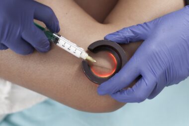 Skleroterapia żylaków – na czym polega, jak działa i jakie przynosi efekty