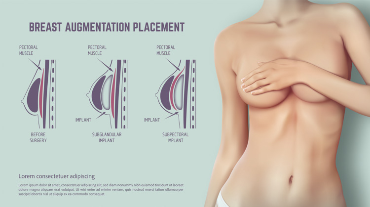 umieszczenie implantu