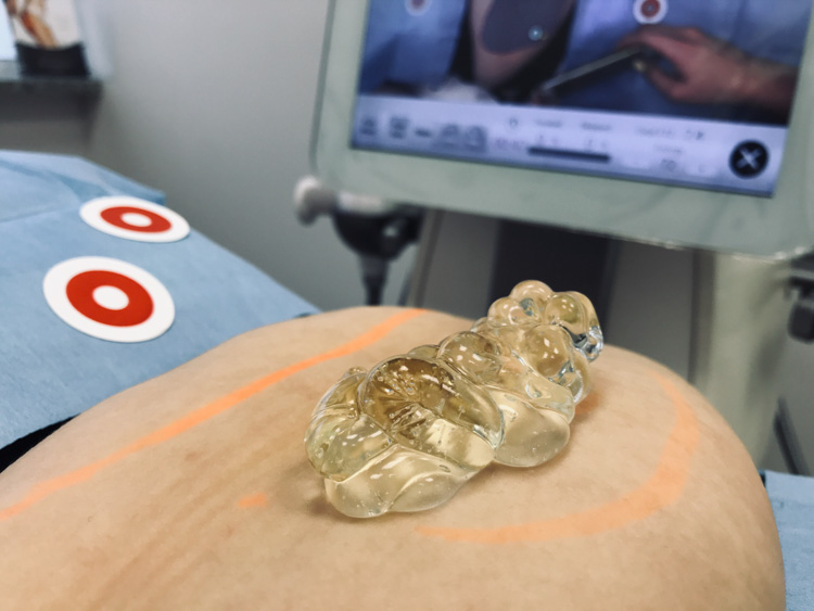 ultrashape wrocław