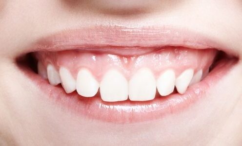 Gummy smile (uśmiech dziąsłowy)
