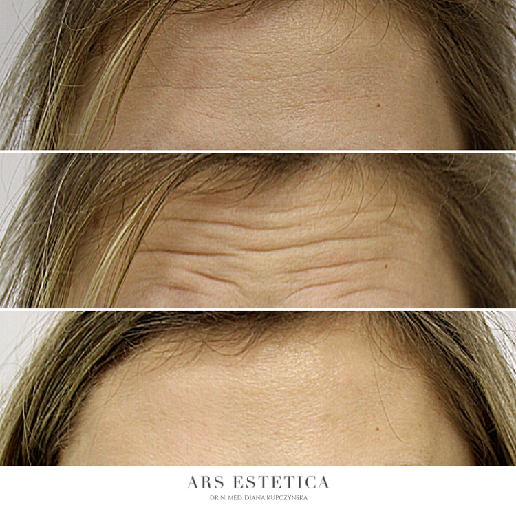 botoks na czoło
