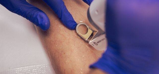 Teleangiektazje – miejsce występowania, przyczyny i leczenie