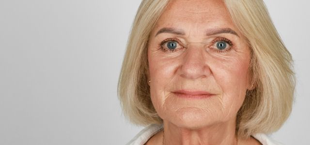 Blefaroplastyka – historia pacjentki. czy warto zrobić plastykę powiek górnych?