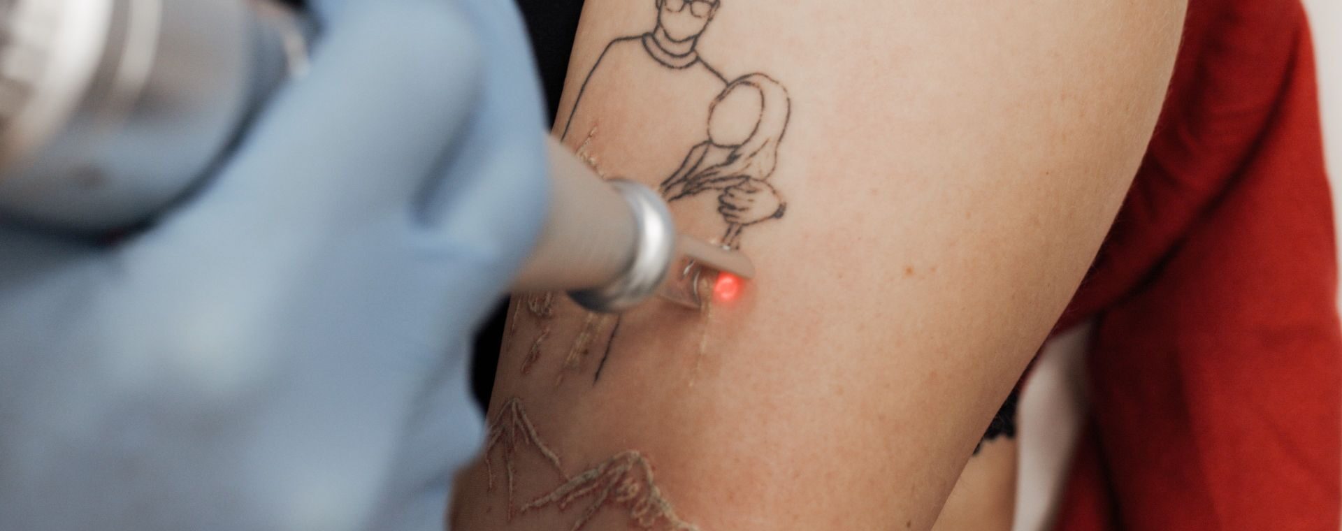 Pielęgnacja skóry po laserowym usuwaniu tatuażu