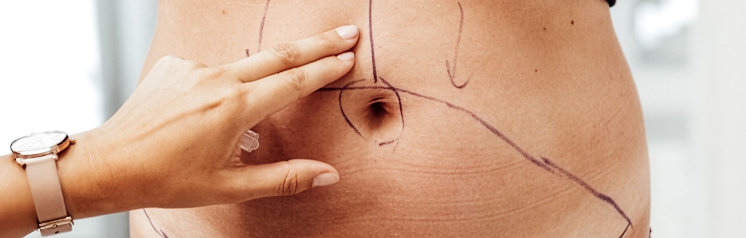 Mommy Makeover – kompleksowa metamorfoza po ciąży krok po kroku