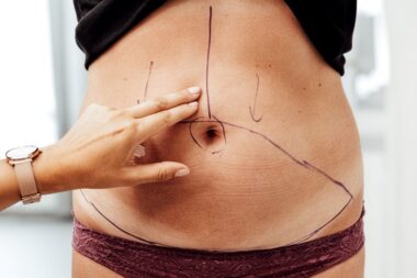 Mommy Makeover – kompleksowa metamorfoza po ciąży krok po kroku