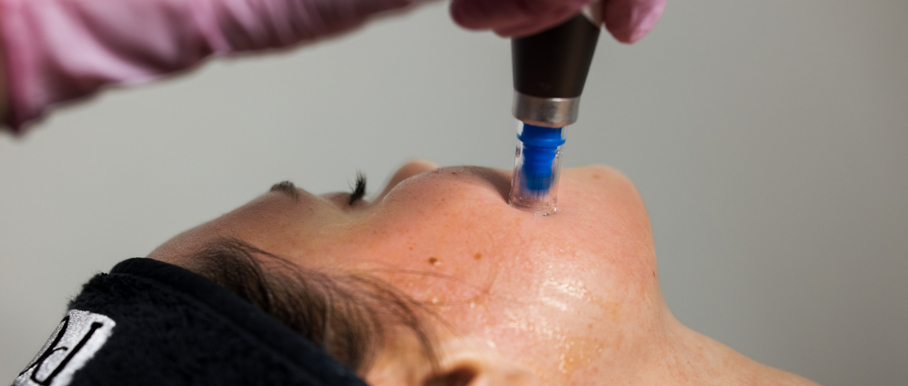 mezoterapia mikroigłowa
