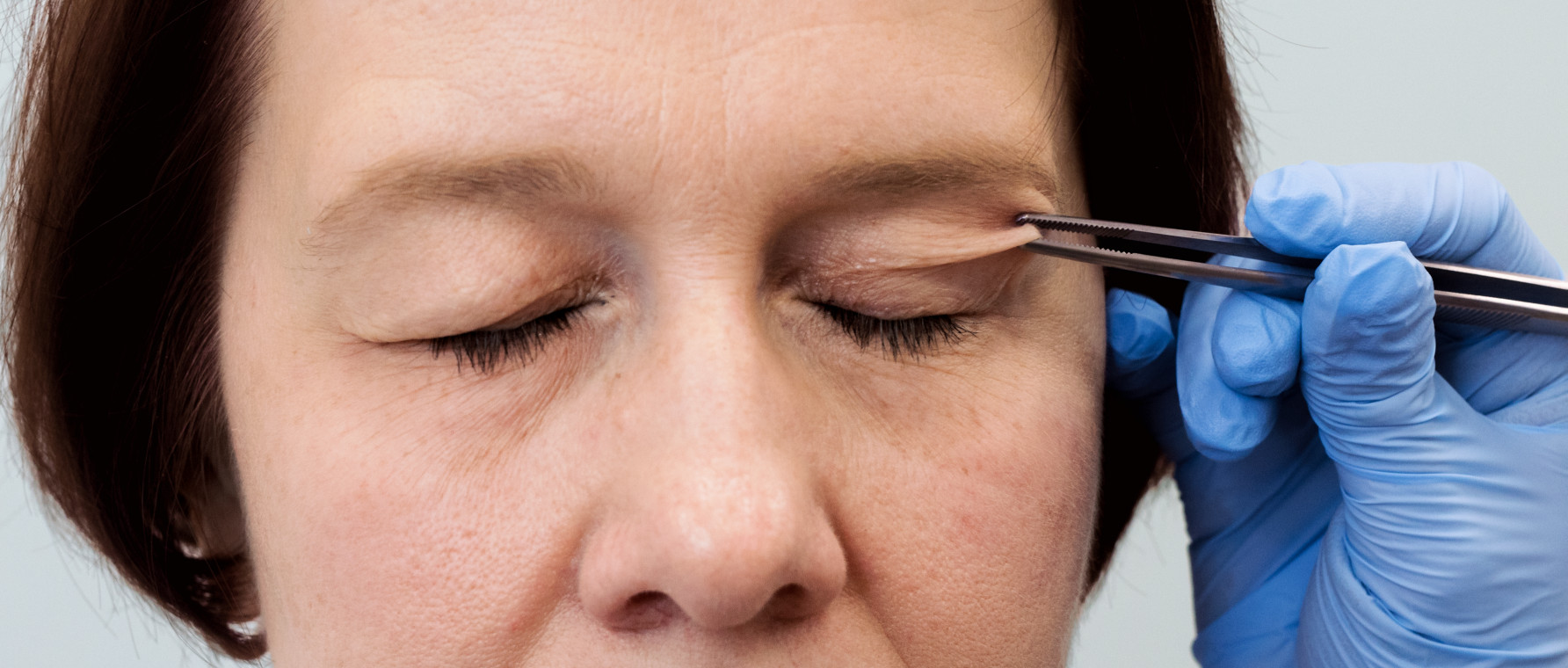 Blefaroplastyka (plastyka powiek)