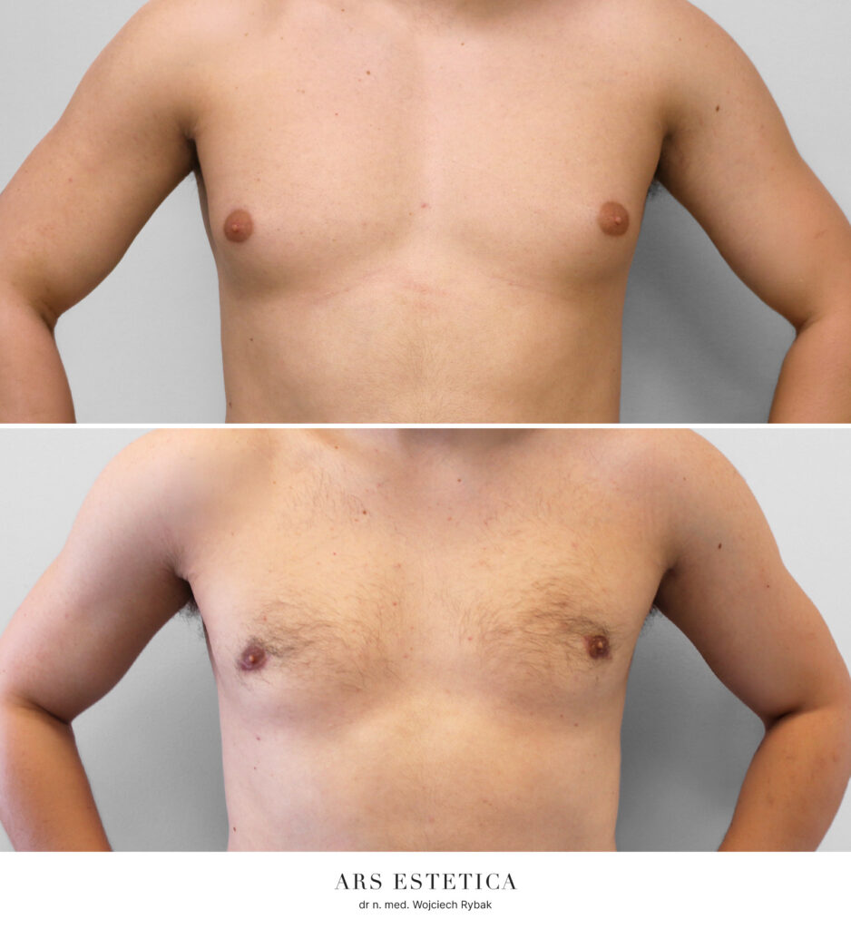 Efekt operacji ginekomastii – po lewej stan przed zabiegiem, po prawej wynik 3 miesiące po operacji, ujęcie z przodu.