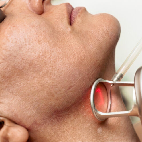 Dermabrazja laserowa