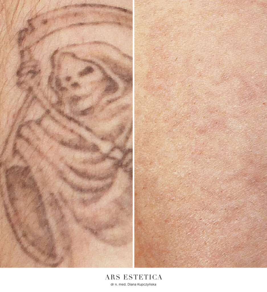 Laserowe usuwanie tatuażu – przed i po, po lewej stan przed, po prawej wynik po 4 zabiegach laserowych.