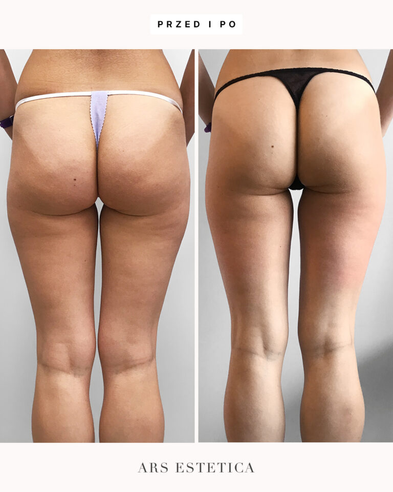 Liposhock efekt przed i po