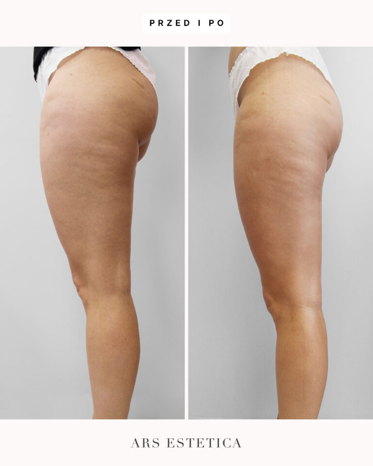 liposhock przed i po