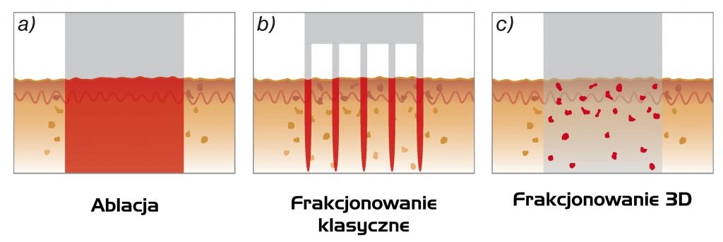 fotona schemat działania