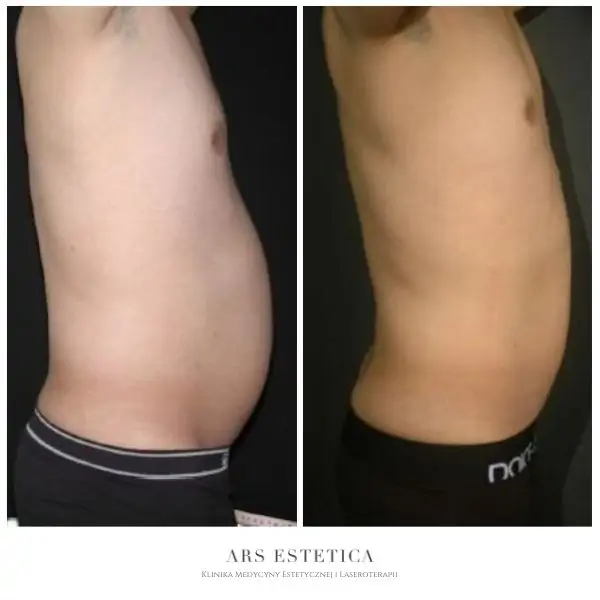 efekty zabiegu ultrashape