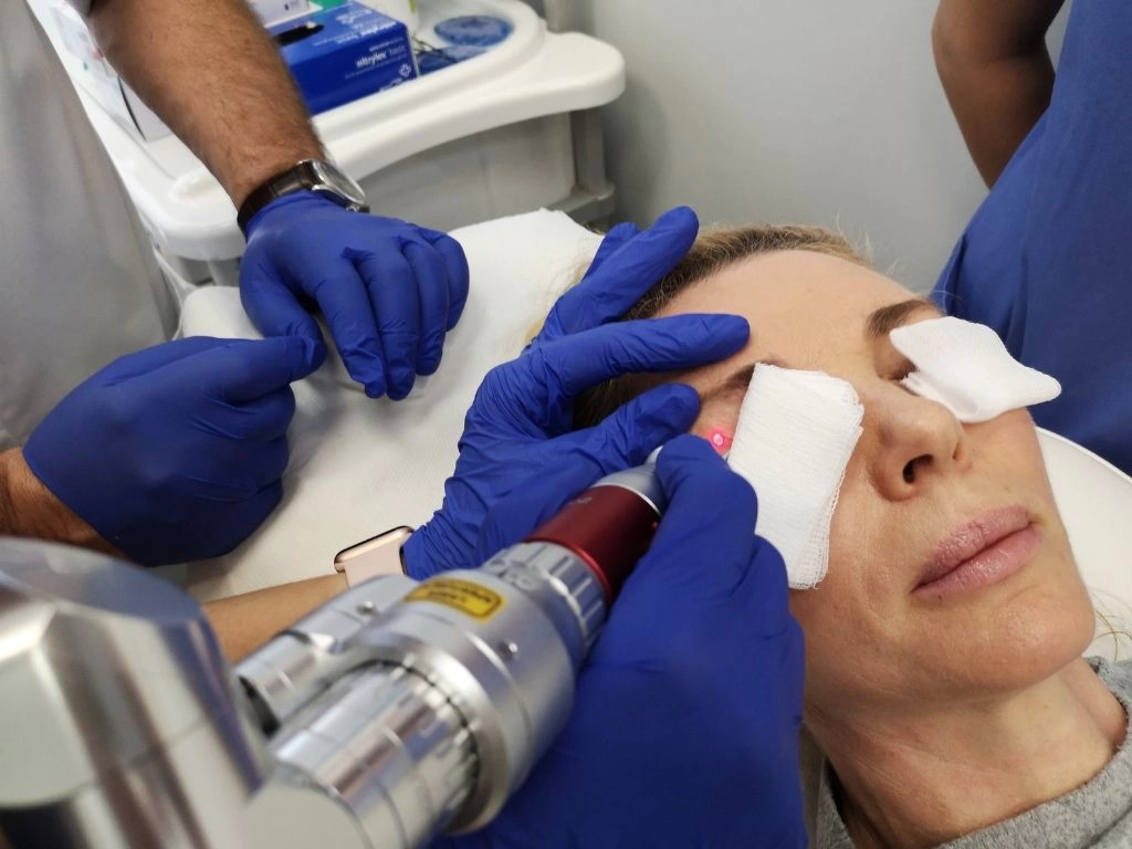 laserowe usuwanie przebarwień