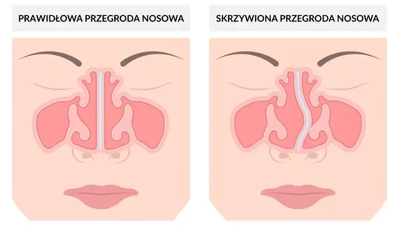 przegroda nosowa skrzywiona i prawidlowa